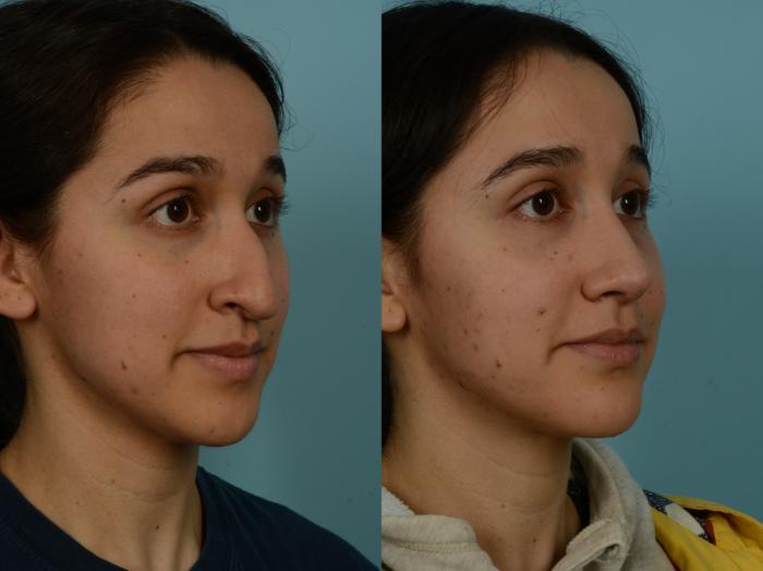 Before & After Rhinoplasty by Dr. Sinno Case 1028 Right Oblique View in Chicago, IL