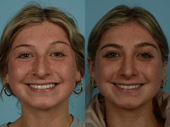 Before & After Rhinoplasty by Dr. Sinno Case 1029 Front View in Chicago, IL