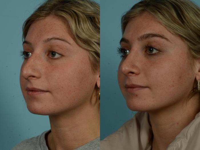 Before & After Rhinoplasty by Dr. Sinno Case 1029 Left Oblique View in Chicago, IL