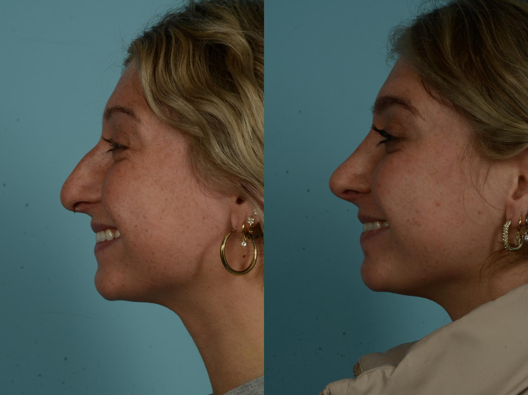 Before & After Rhinoplasty by Dr. Sinno Case 1029 Left Side View in Chicago, IL