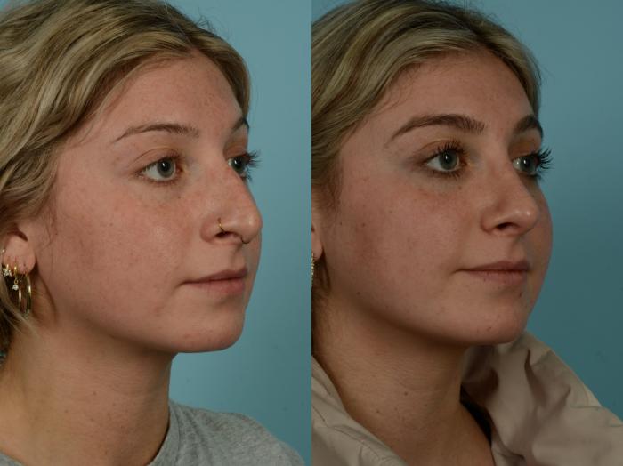 Before & After Rhinoplasty by Dr. Sinno Case 1029 Right Oblique View in Chicago, IL