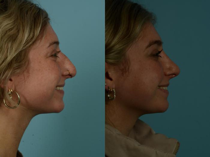 Before & After Rhinoplasty by Dr. Sinno Case 1029 Right Side View in Chicago, IL