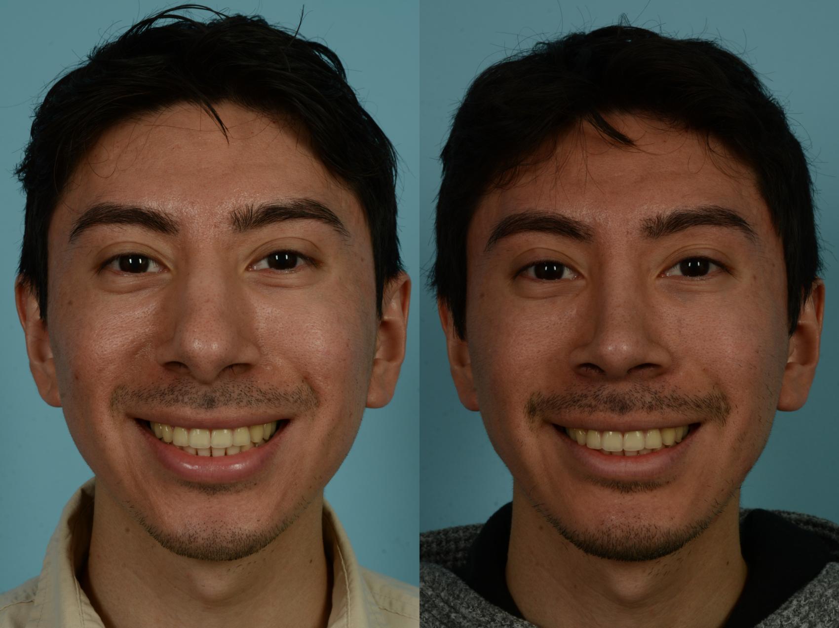 Before & After Rhinoplasty by Dr. Sinno Case 1030 Front View in Chicago, IL