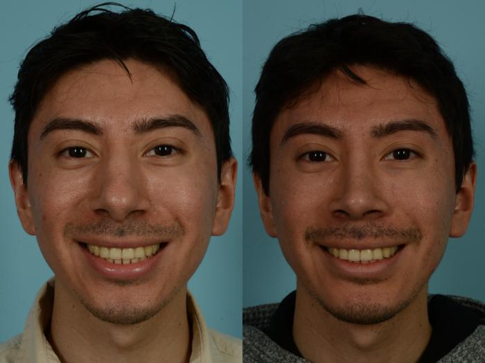 Before & After Rhinoplasty by Dr. Sinno Case 1030 Front View in Chicago, IL