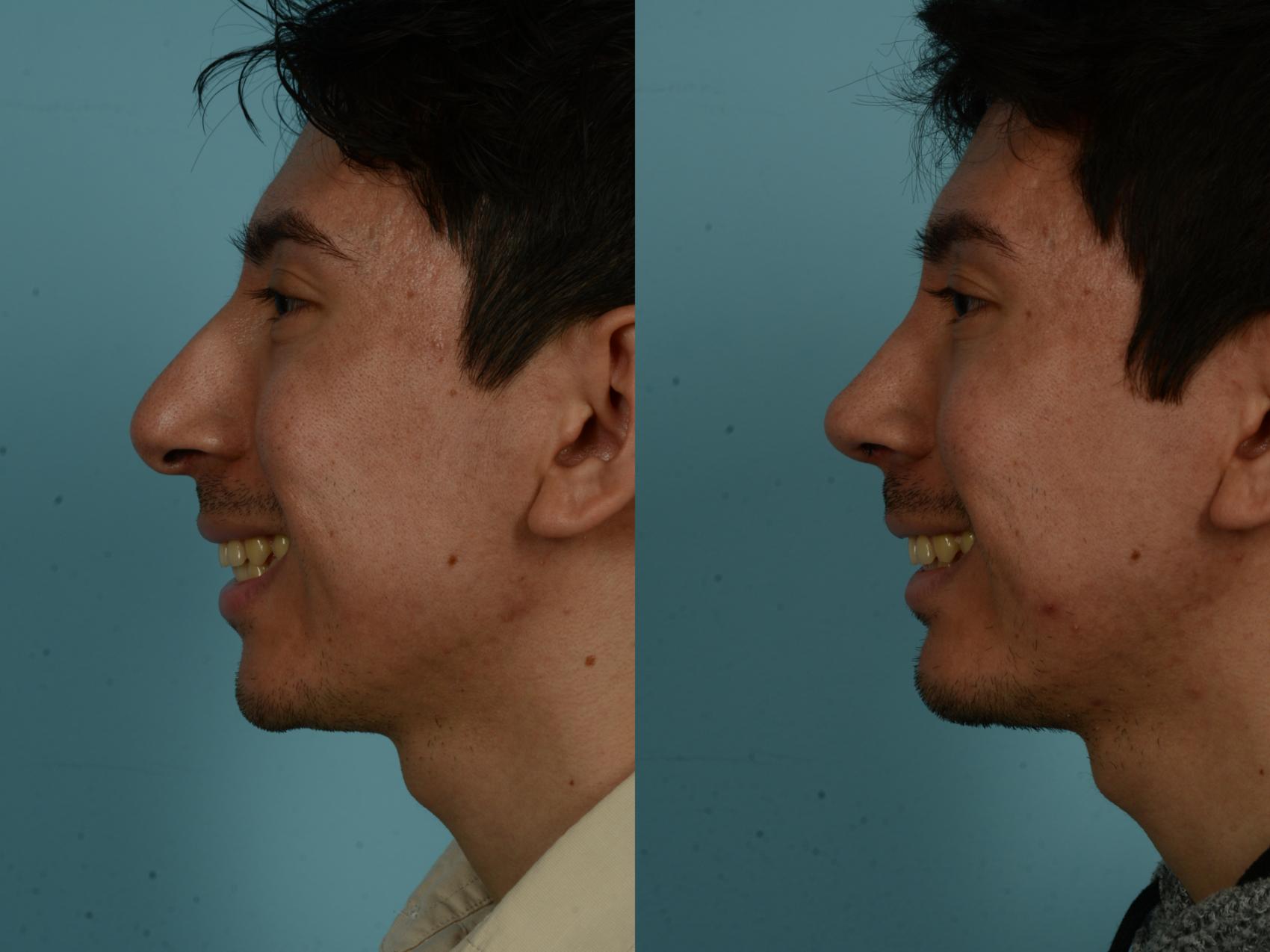 Before & After Rhinoplasty by Dr. Sinno Case 1030 Left Side View in Chicago, IL