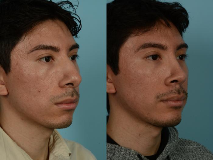 Before & After Rhinoplasty by Dr. Sinno Case 1030 Right Oblique View in Chicago, IL