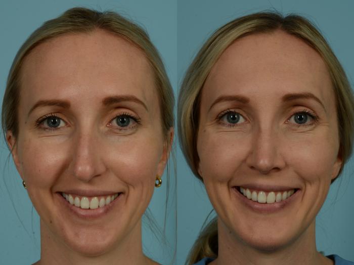 Before & After Rhinoplasty by Dr. Sinno Case 1031 Front View in Chicago, IL