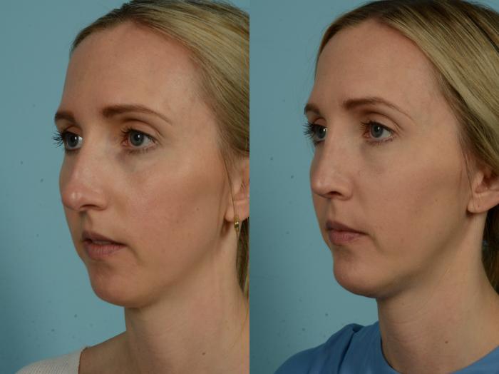 Before & After Rhinoplasty by Dr. Sinno Case 1031 Left Oblique View in Chicago, IL