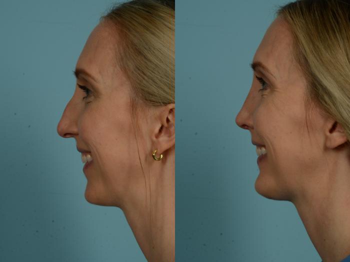 Before & After Rhinoplasty by Dr. Sinno Case 1031 Left Side View in Chicago, IL