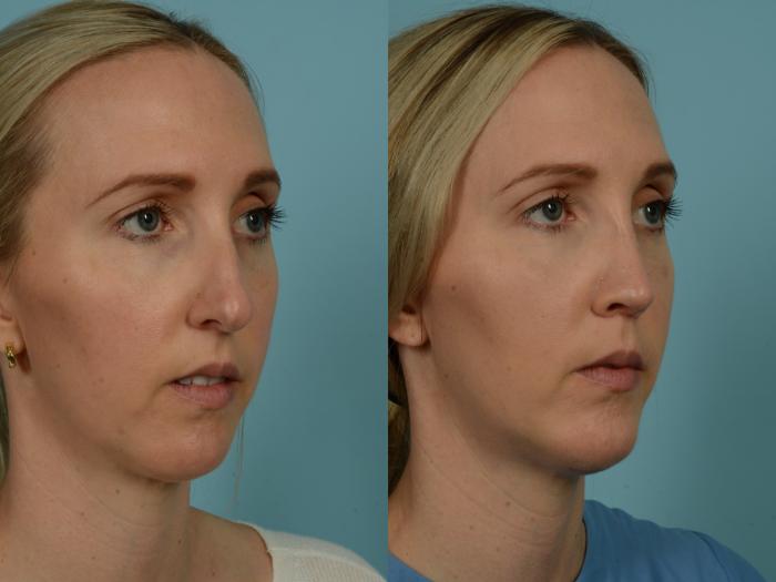 Before & After Rhinoplasty by Dr. Sinno Case 1031 Right Oblique View in Chicago, IL