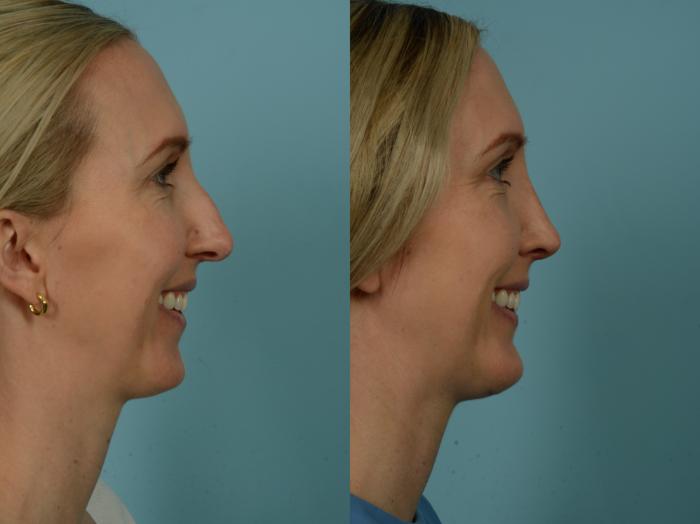 Before & After Rhinoplasty by Dr. Sinno Case 1031 Right Side View in Chicago, IL