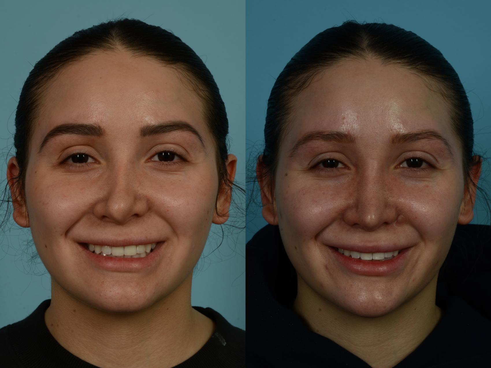 Before & After Rhinoplasty by Dr. Sinno Case 1039 Front View in Chicago, IL