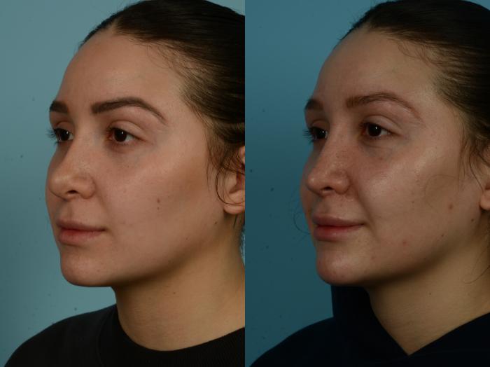 Before & After Rhinoplasty by Dr. Sinno Case 1039 Left Oblique View in Chicago, IL