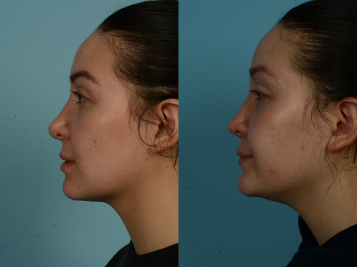 Before & After Rhinoplasty by Dr. Sinno Case 1039 Left Side View in Chicago, IL