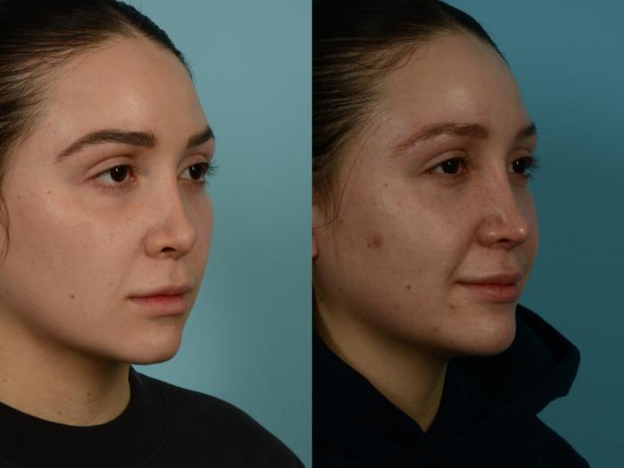 Before & After Rhinoplasty by Dr. Sinno Case 1039 Right Oblique View in Chicago, IL