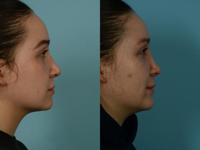 Before & After Rhinoplasty by Dr. Sinno Case 1039 Right Side View in Chicago, IL