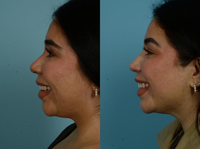 Before & After Rhinoplasty by Dr. Sinno Case 1067 Left Side View in Chicago, IL
