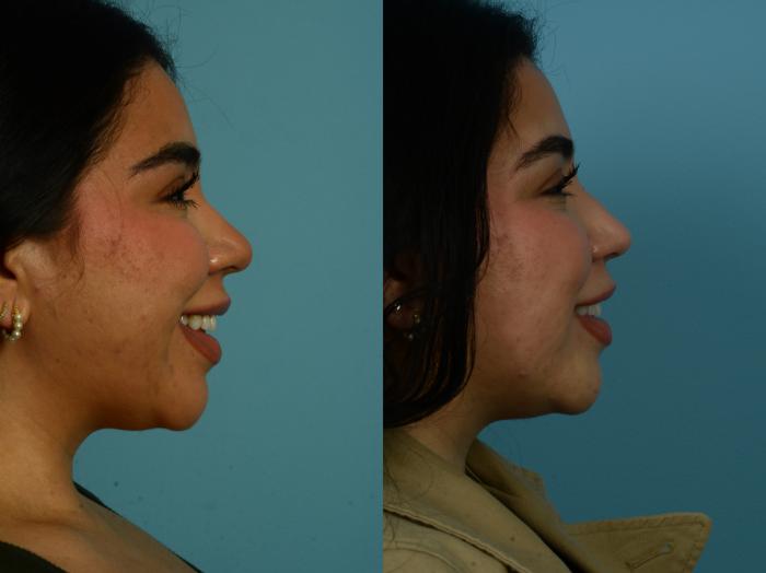 Before & After Rhinoplasty by Dr. Sinno Case 1067 Right Side View in Chicago, IL