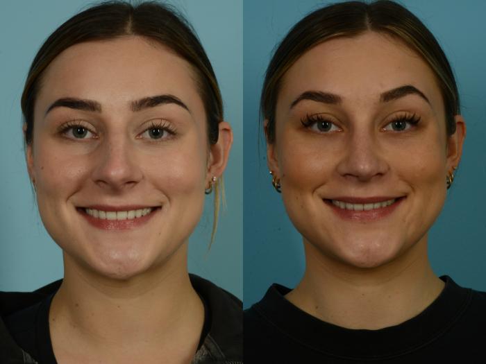 Before & After Rhinoplasty by Dr. Sinno Case 1069 Front View in Chicago, IL