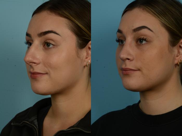 Before & After Rhinoplasty by Dr. Sinno Case 1069 Left Oblique View in Chicago, IL