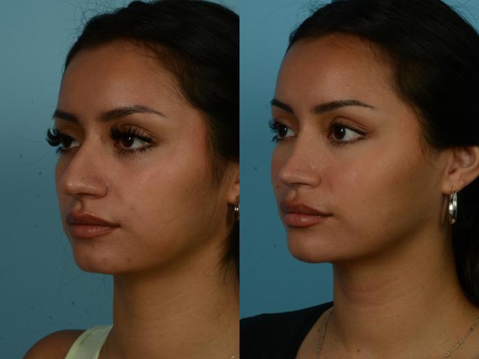 Before & After Rhinoplasty by Dr. Sinno Case 1071 Left Oblique View in Chicago, IL