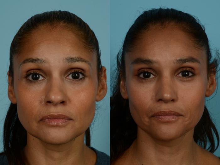 Before & After Rhinoplasty by Dr. Sinno Case 1097 Front View in Chicago, IL