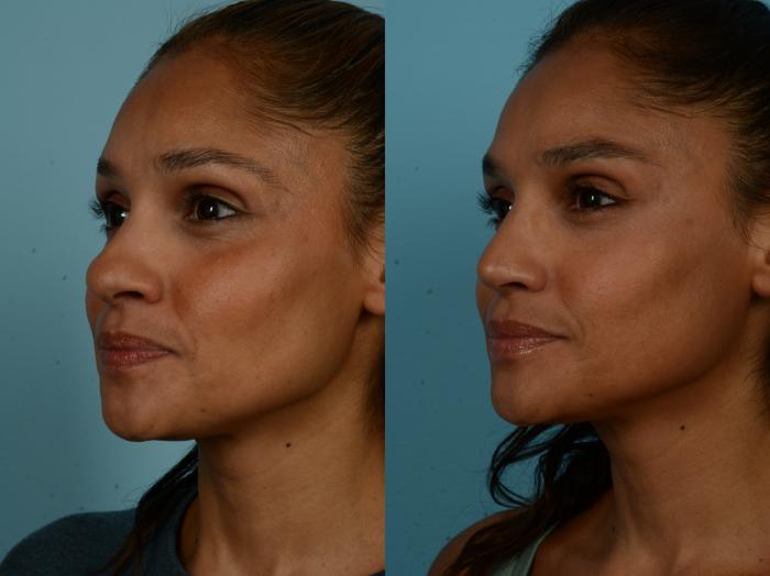 Before & After Rhinoplasty by Dr. Sinno Case 1097 Left Oblique View in Chicago, IL