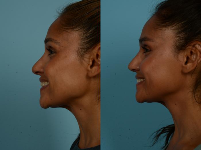 Before & After Rhinoplasty by Dr. Sinno Case 1097 Left Side View in Chicago, IL