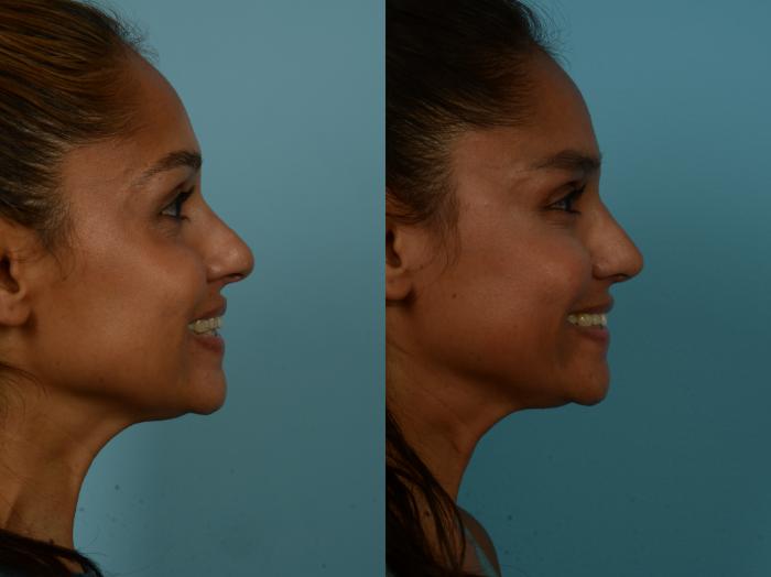 Before & After Rhinoplasty by Dr. Sinno Case 1097 Right Side View in Chicago, IL