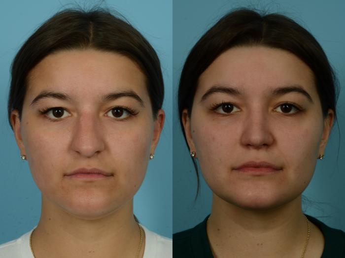 Before & After Rhinoplasty by Dr. Sinno Case 1116 Front View in Chicago, IL