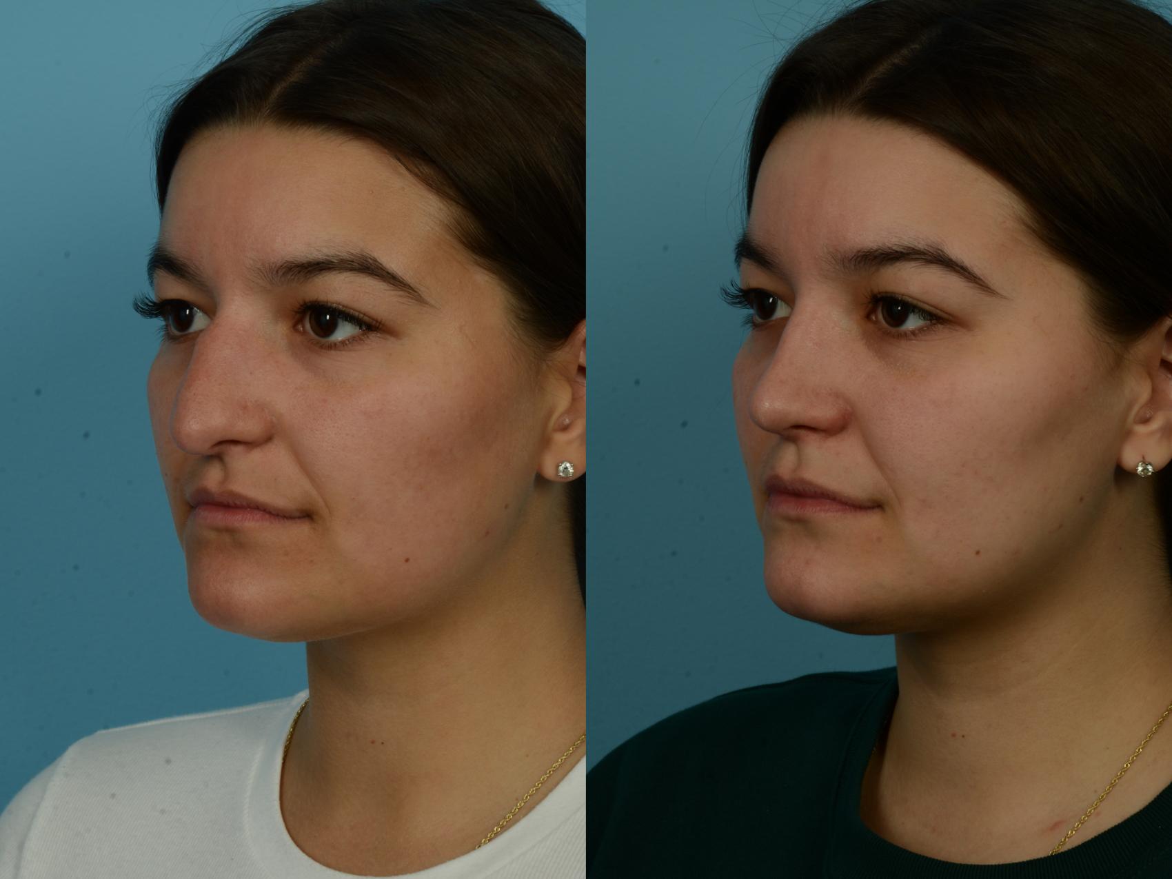 Before & After Rhinoplasty by Dr. Sinno Case 1116 Left Oblique View in Chicago, IL