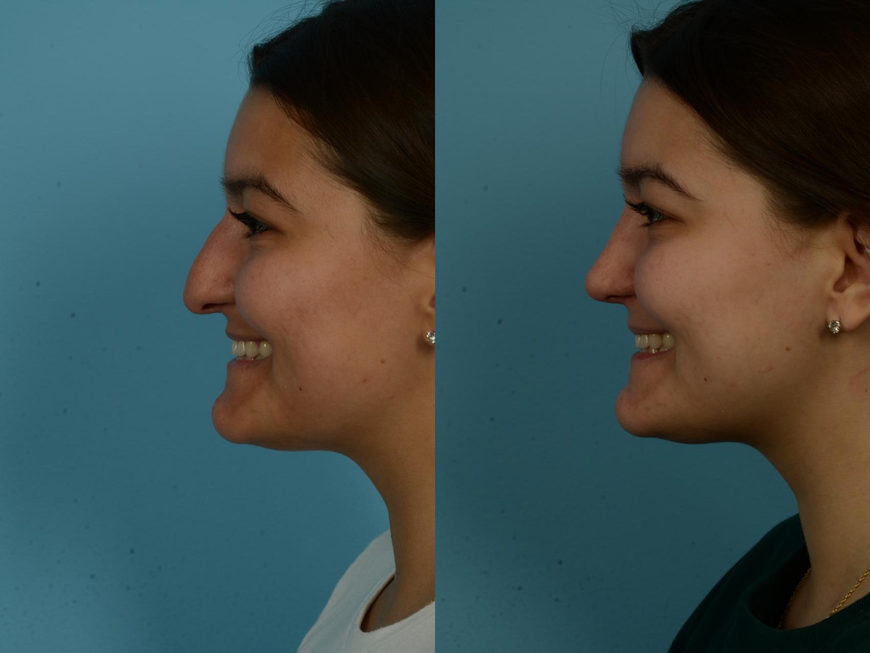 Before & After Rhinoplasty by Dr. Sinno Case 1116 Left Side View in Chicago, IL