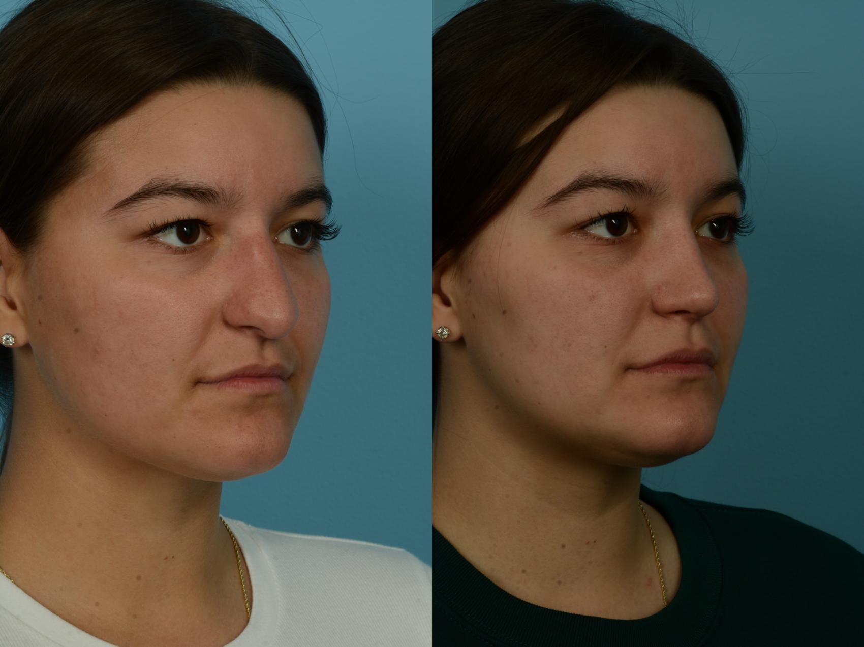 Before & After Rhinoplasty by Dr. Sinno Case 1116 Right Oblique View in Chicago, IL