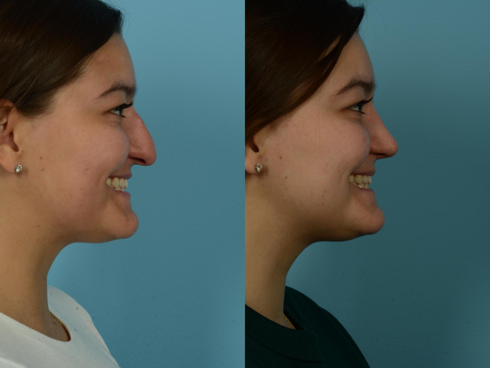Before & After Rhinoplasty by Dr. Sinno Case 1116 Right Side View in Chicago, IL