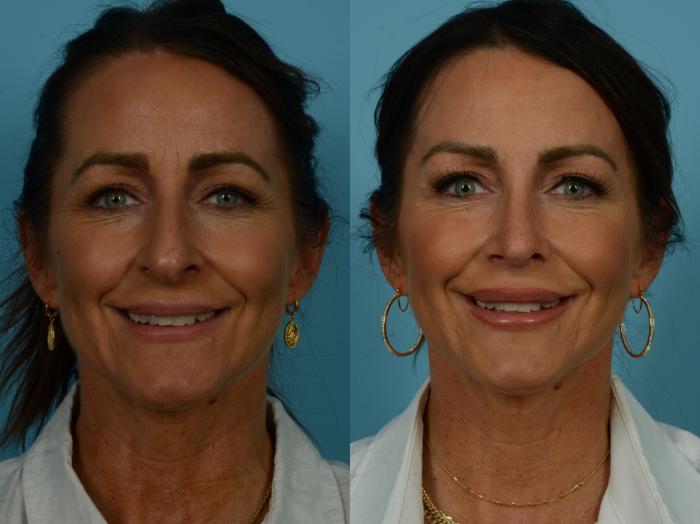 Before & After Rhinoplasty by Dr. Sinno Case 1117 Front View in Chicago, IL