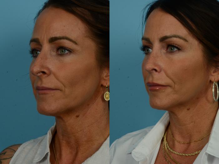 Before & After Rhinoplasty by Dr. Sinno Case 1117 Left Oblique View in Chicago, IL