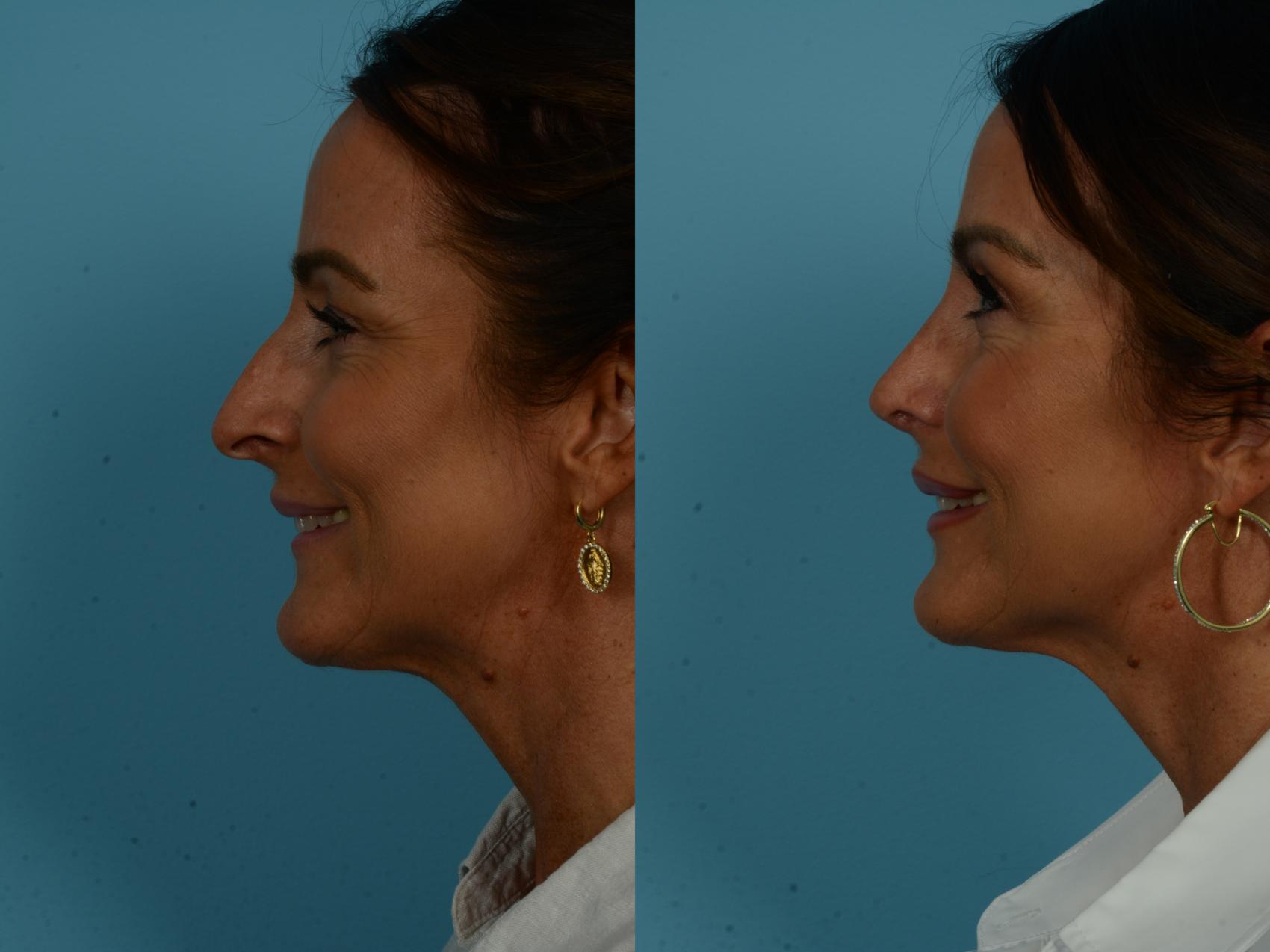 Before & After Rhinoplasty by Dr. Sinno Case 1117 Left Side View in Chicago, IL