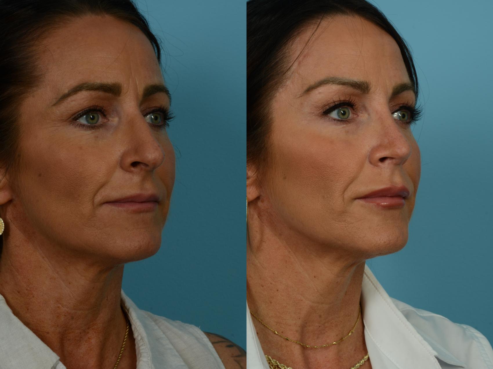 Before & After Rhinoplasty by Dr. Sinno Case 1117 Right Oblique View in Chicago, IL