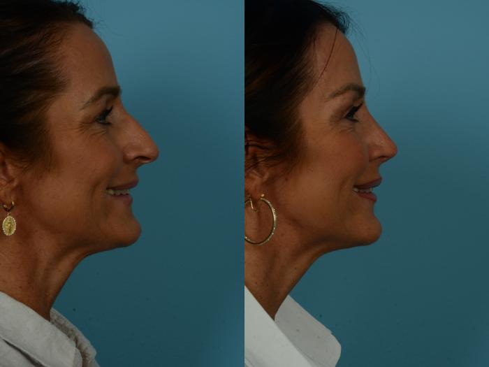 Before & After Rhinoplasty by Dr. Sinno Case 1117 Right Side View in Chicago, IL