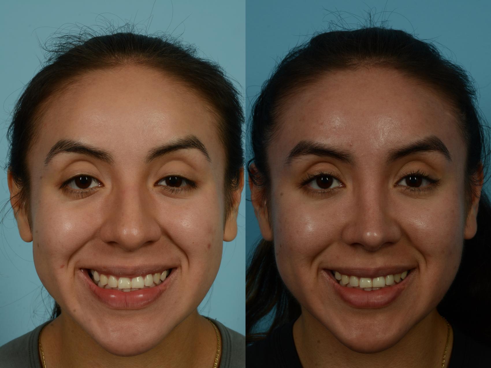 Before & After Rhinoplasty by Dr. Sinno Case 1121 Front View in Chicago, IL