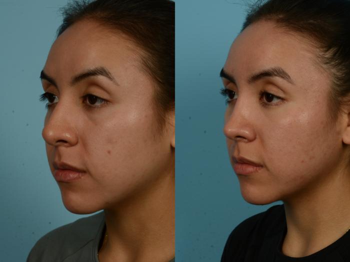 Before & After Rhinoplasty by Dr. Sinno Case 1121 Left Oblique View in Chicago, IL