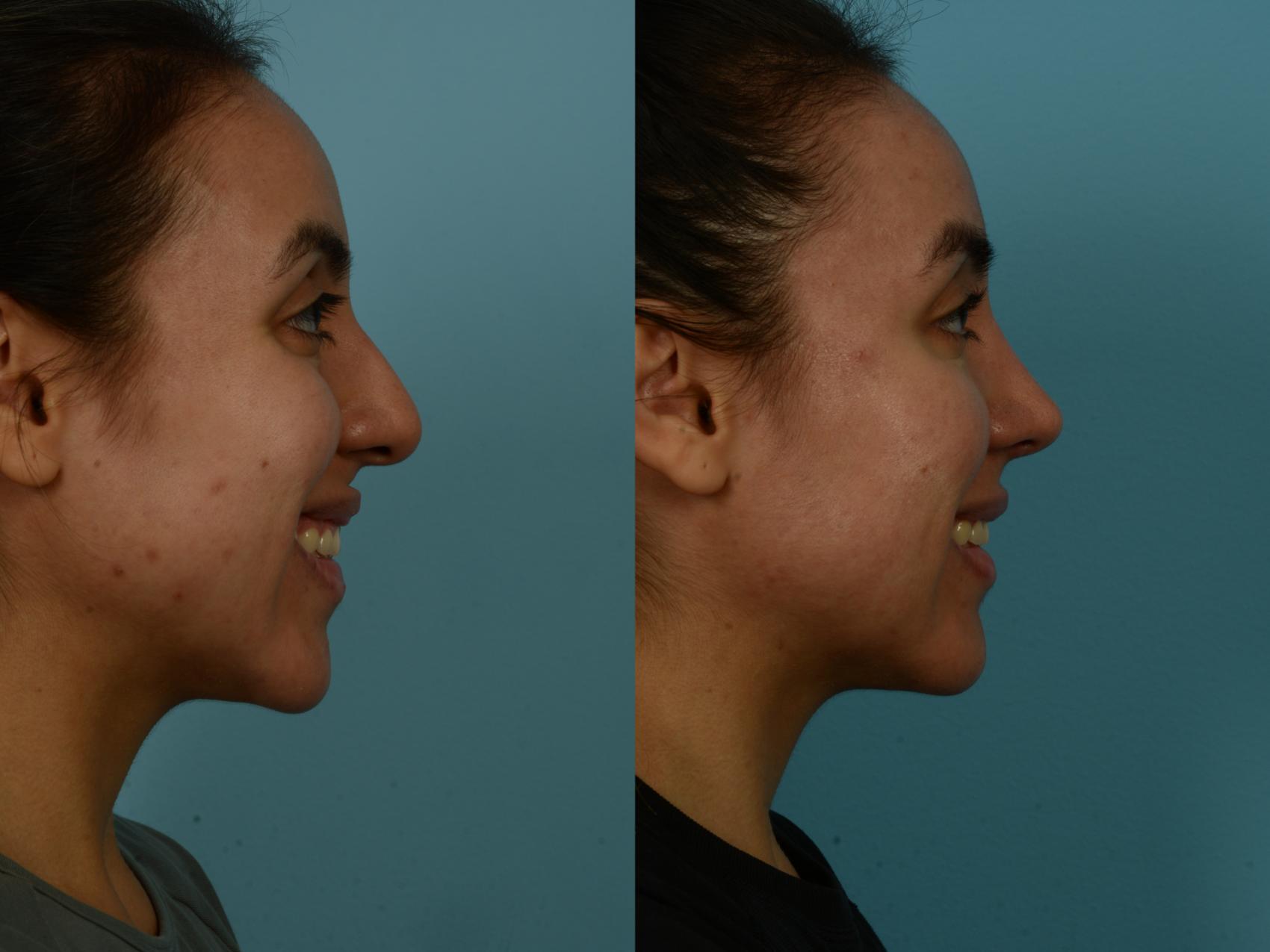 Before & After Rhinoplasty by Dr. Sinno Case 1121 Right Side View in Chicago, IL