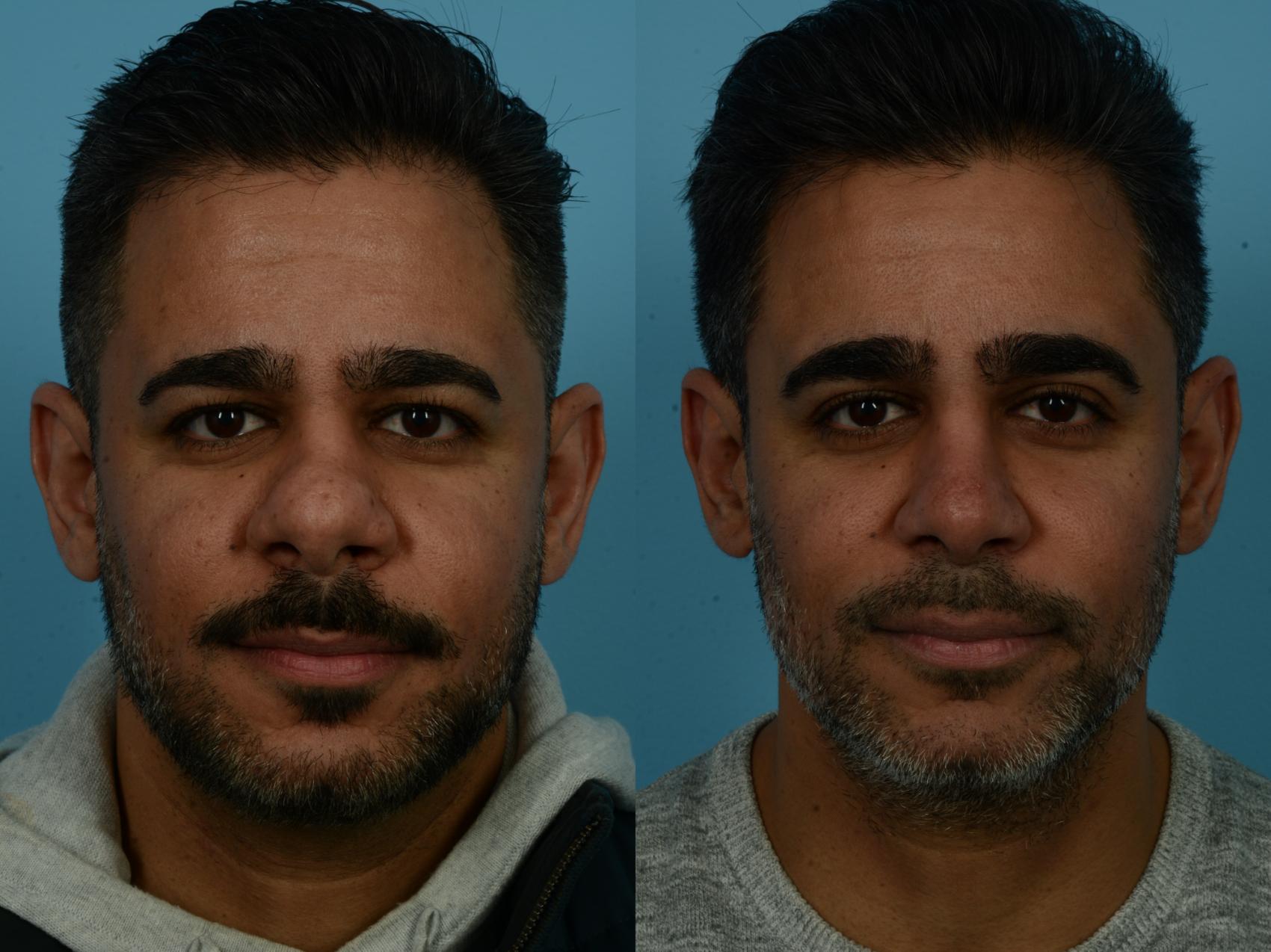 Before & After Rhinoplasty by Dr. Sinno Case 1124 Front View in Chicago, IL