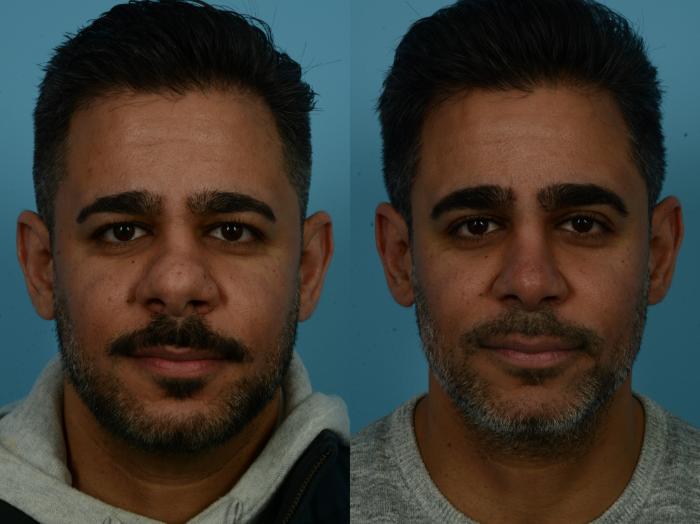 Before & After Rhinoplasty by Dr. Sinno Case 1124 Front View in Chicago, IL
