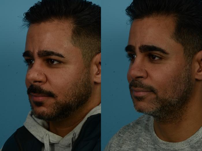 Before & After Rhinoplasty by Dr. Sinno Case 1124 Left Oblique View in Chicago, IL