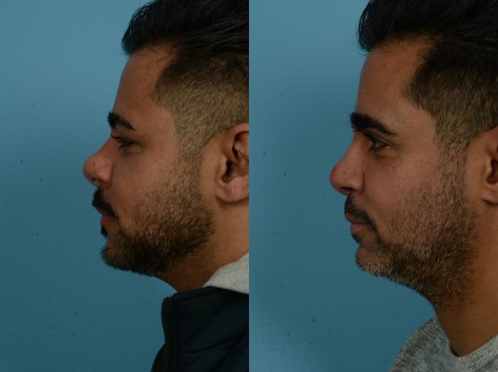 Before & After Rhinoplasty by Dr. Sinno Case 1124 Left Side View in Chicago, IL