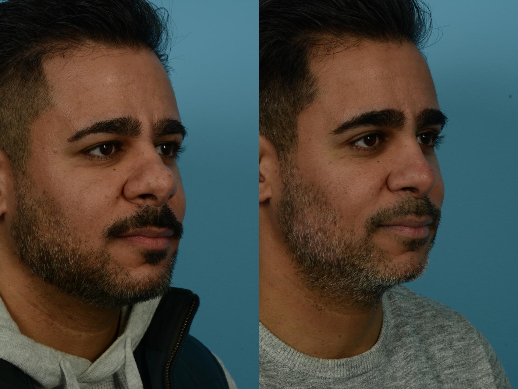 Before & After Rhinoplasty by Dr. Sinno Case 1124 Right Oblique View in Chicago, IL