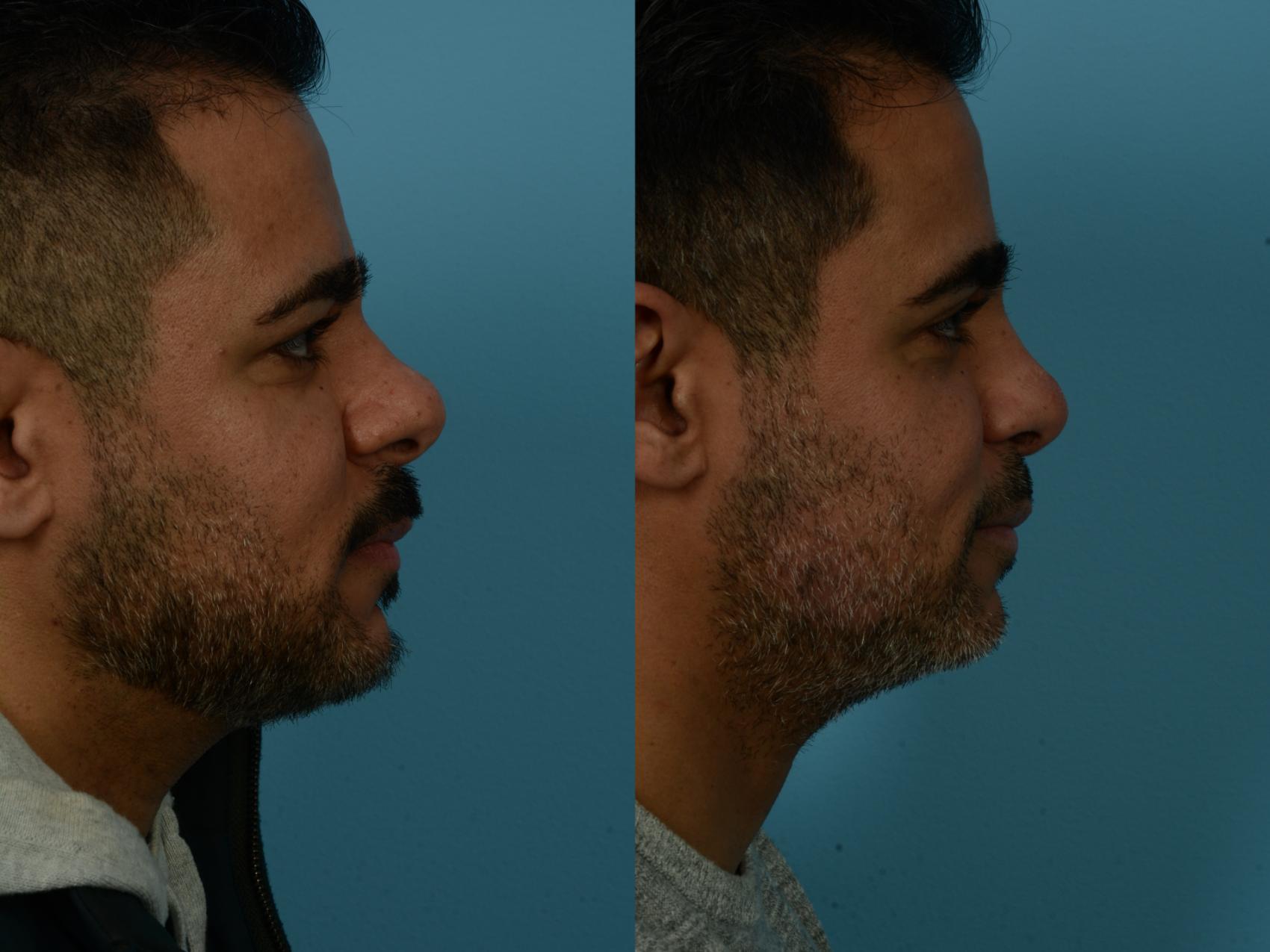 Before & After Rhinoplasty by Dr. Sinno Case 1124 Right Side View in Chicago, IL