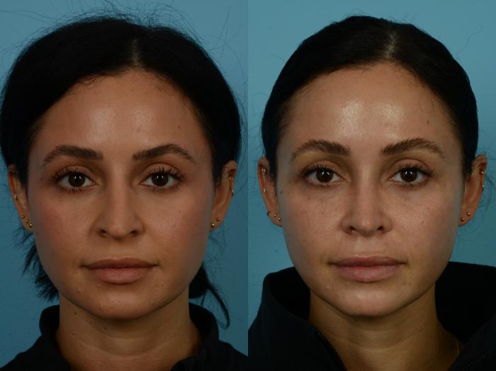 Before & After Rhinoplasty by Dr. Sinno Case 1126 Front View in Chicago, IL