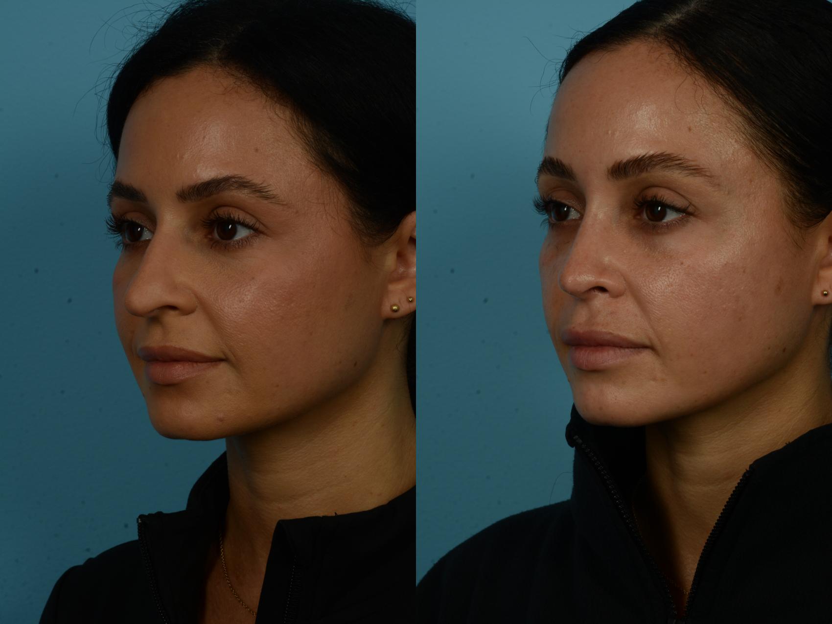 Before & After Rhinoplasty by Dr. Sinno Case 1126 Left Oblique View in Chicago, IL